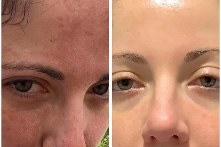 Microneedling & Peels