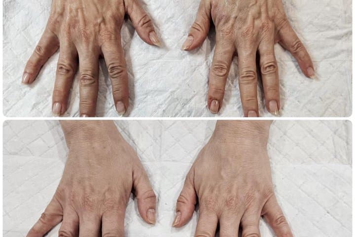 Hand Rejuvenation